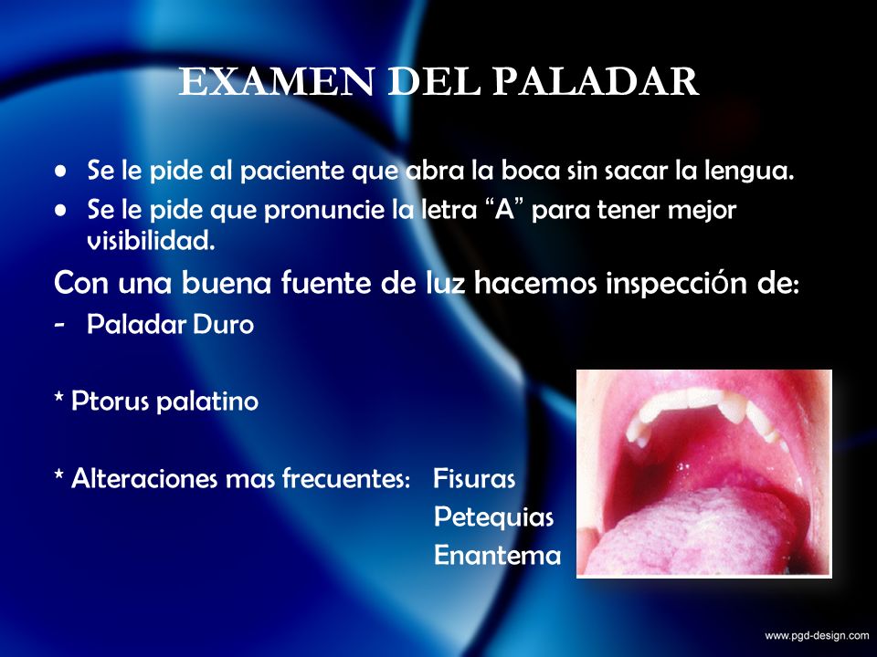 EXAMEN DEL PALADAR Con una buena fuente de luz hacemos inspección de: