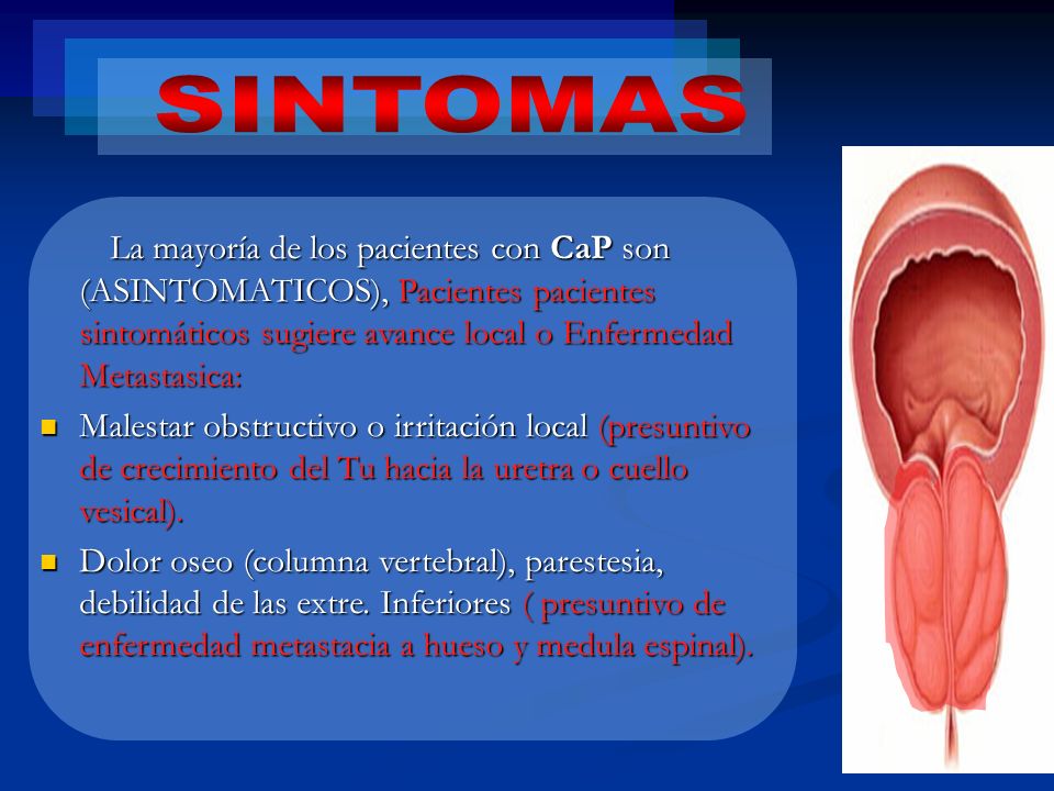 SINTOMAS La mayoría de los pacientes con CaP son (ASINTOMATICOS), Pacientes pacientes sintomáticos sugiere avance local o Enfermedad Metastasica: