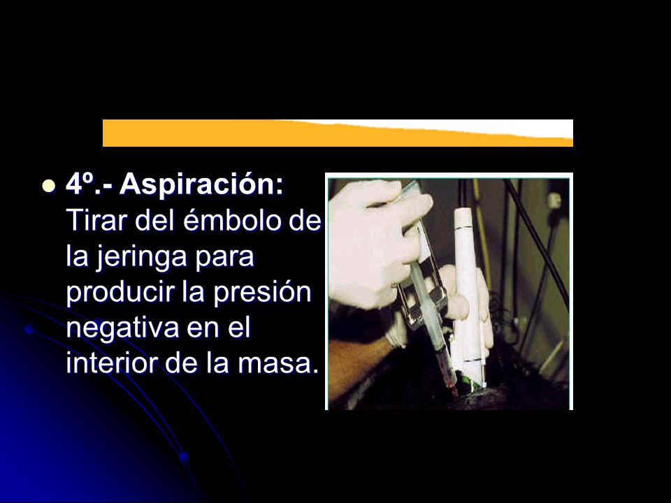 4º.- Aspiración: Tirar del émbolo de la jeringa para producir la presión negativa en el interior de la masa.