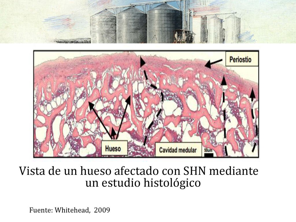 Vista de un hueso afectado con SHN mediante un estudio histológico