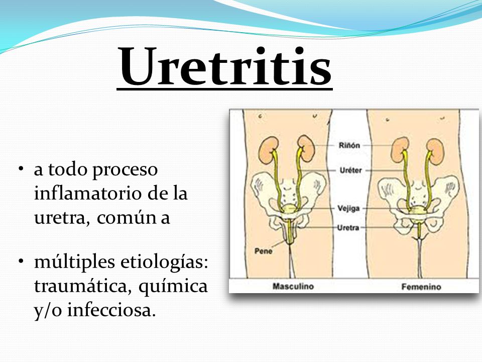 Uretritis a todo proceso inflamatorio de la uretra, común a
