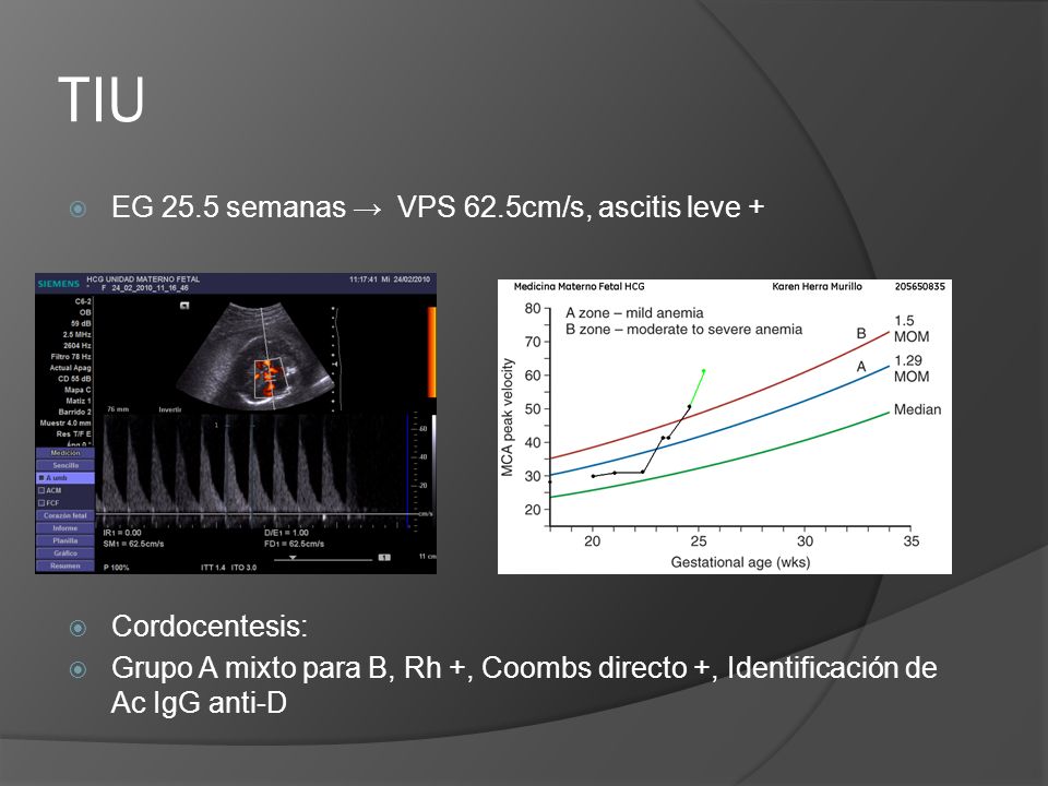 TIU EG 25.5 semanas → VPS 62.5cm/s, ascitis leve + Cordocentesis: