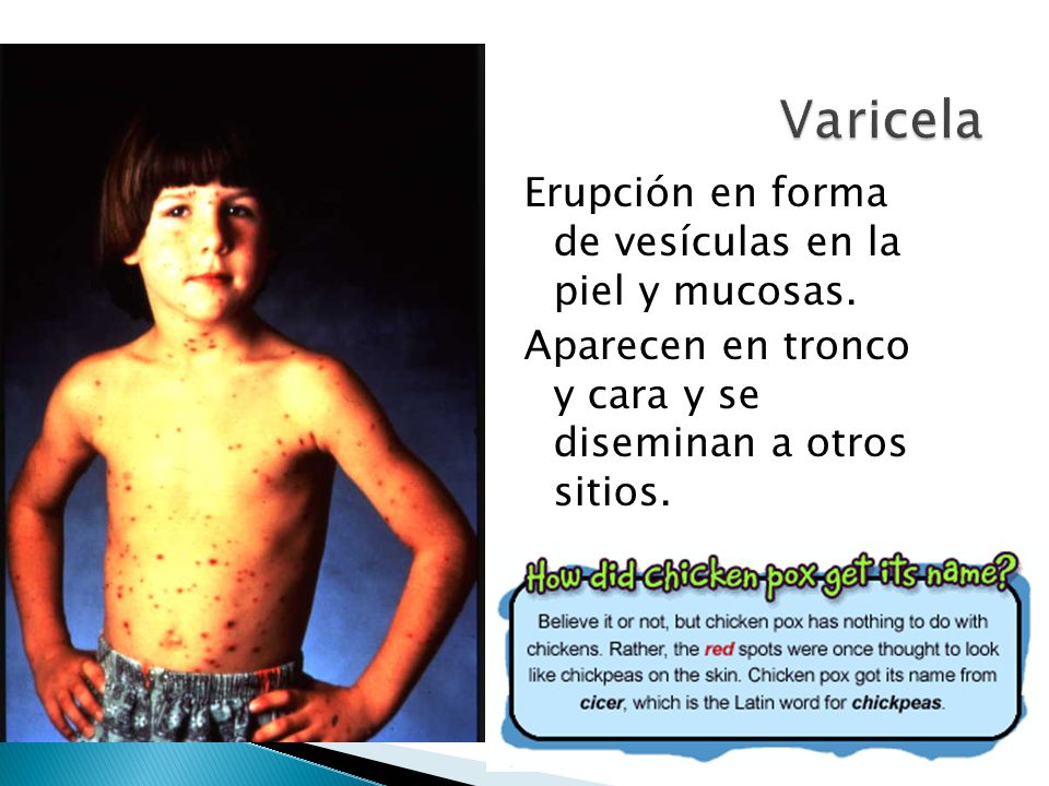 Varicela Erupción en forma de vesículas en la piel y mucosas.