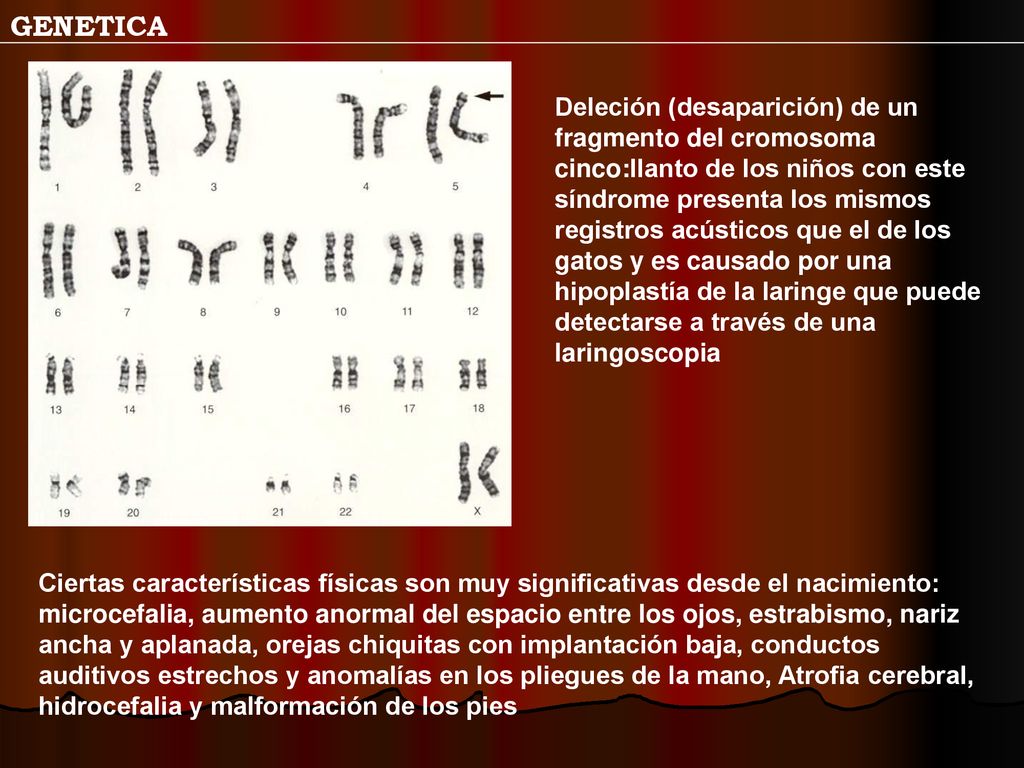 Deleción (desaparición) de un fragmento del cromosoma cinco:llanto de los niños con este síndrome presenta los mismos registros acústicos que el de los gatos y es causado por una hipoplastía de la laringe que puede detectarse a través de una laringoscopia