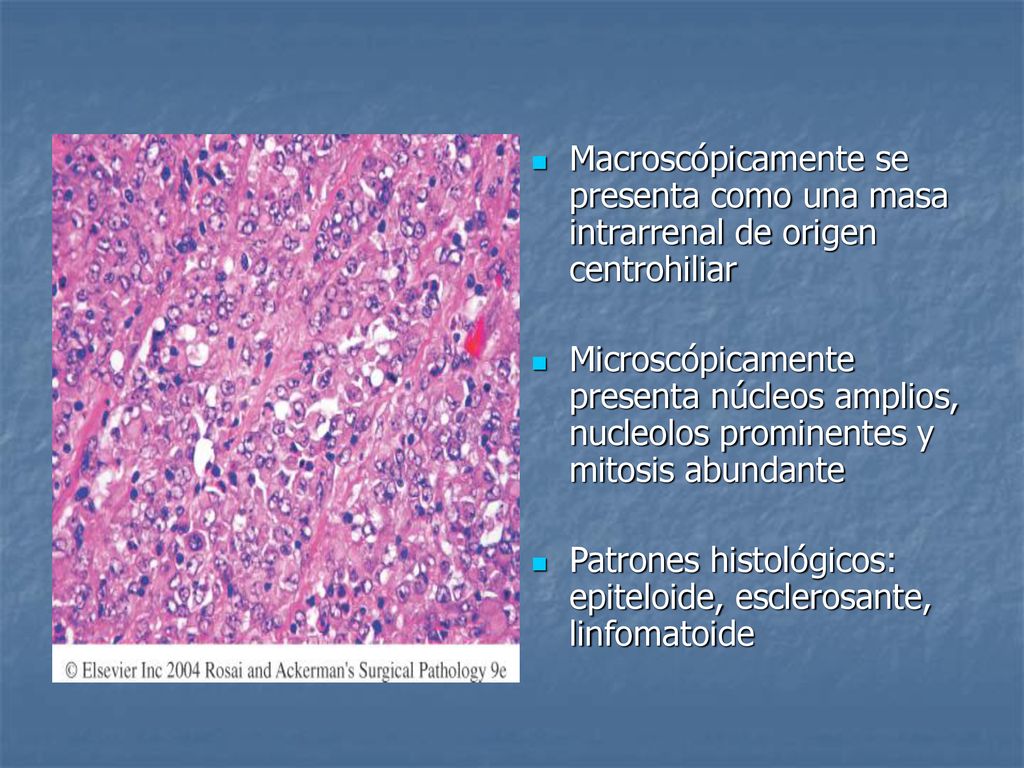 Macroscópicamente se presenta como una masa intrarrenal de origen centrohiliar