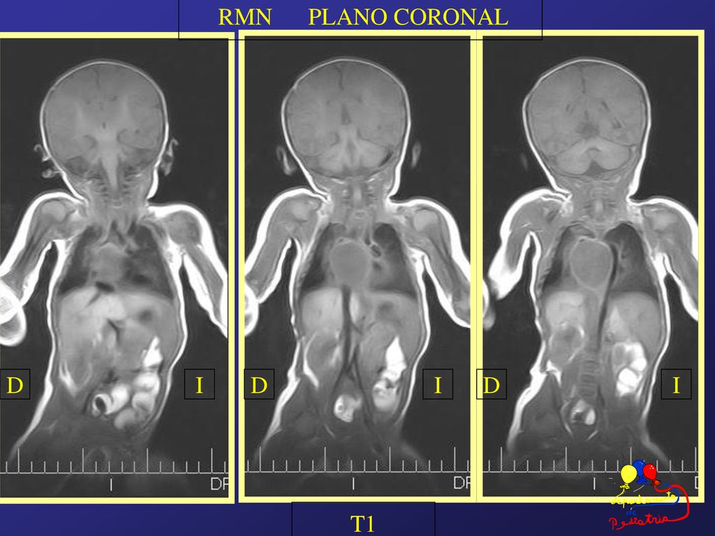 RMN PLANO CORONAL D I D I D I T1