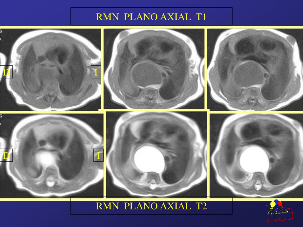RMN PLANO AXIAL T1 D I D I RMN PLANO AXIAL T2