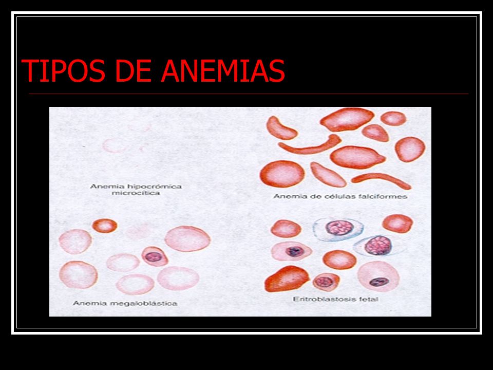 TIPOS DE ANEMIAS Anemias Anemia por perdida de sangre