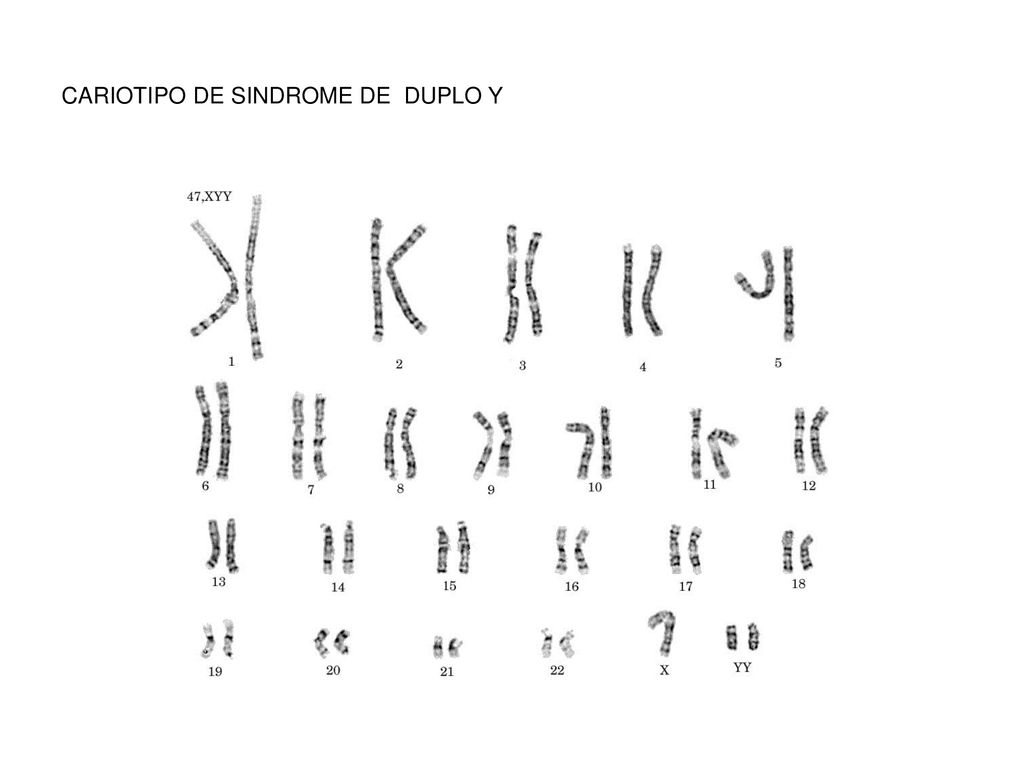CARIOTIPO DE SINDROME DE DUPLO Y