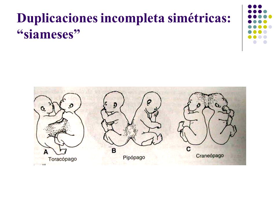Duplicaciones incompleta simétricas: siameses