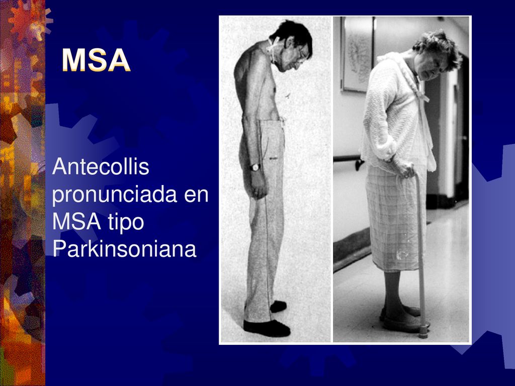 MSA Antecollis pronunciada en MSA tipo Parkinsoniana