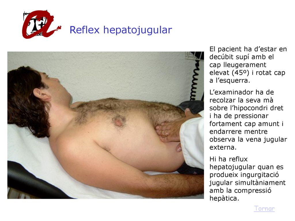 Reflex hepatojugular El pacient ha d’estar en decúbit supí amb el cap lleugerament elevat (45º) i rotat cap a l’esquerra.