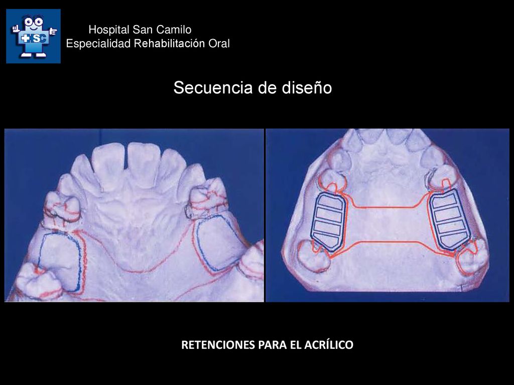 Secuencia de diseño RETENCIONES PARA EL ACRÍLICO Hospital San Camilo