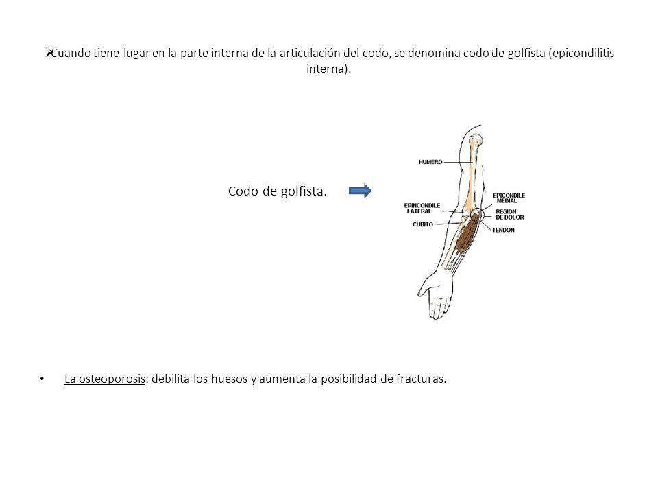 Cuando tiene lugar en la parte interna de la articulación del codo, se denomina codo de golfista (epicondilitis interna).