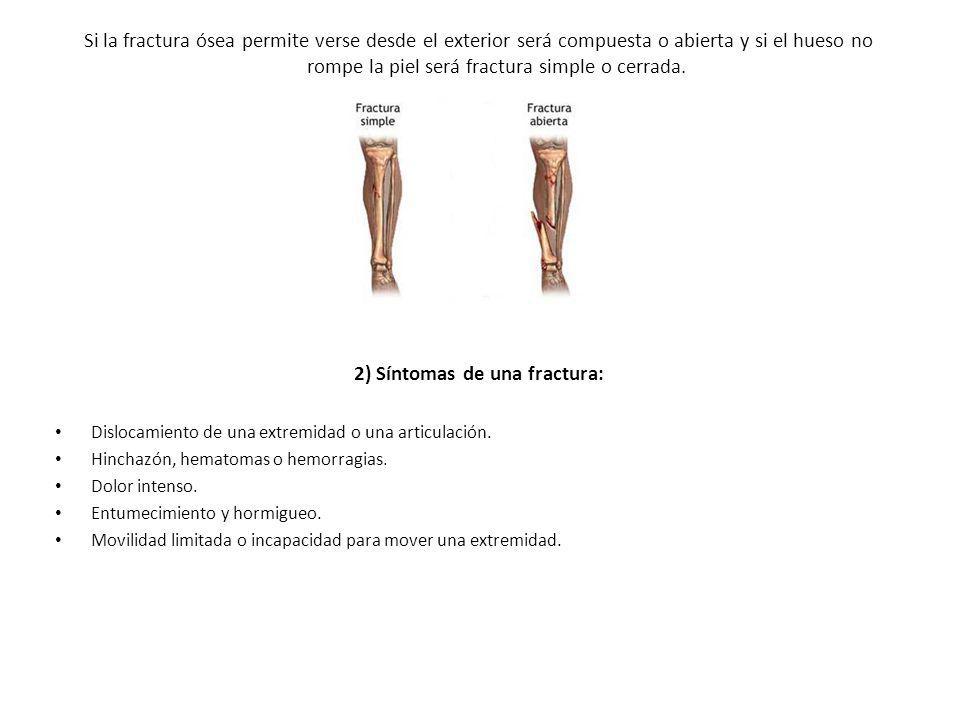 2) Síntomas de una fractura: