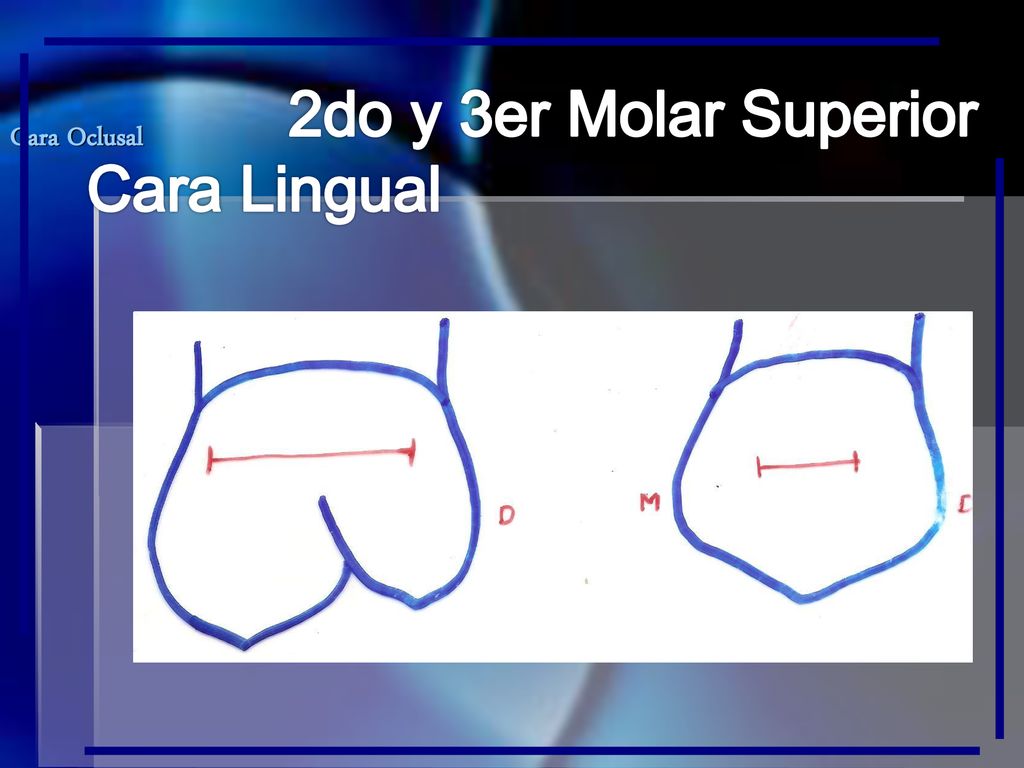 2do y 3er Molar Superior Cara Lingual Cara Oclusal