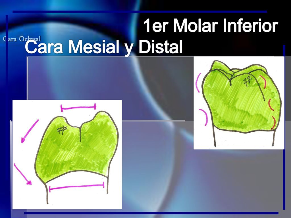 1er Molar Inferior Cara Mesial y Distal Cara Oclusal