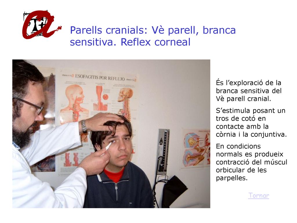 Parells cranials: Vè parell, branca sensitiva. Reflex corneal