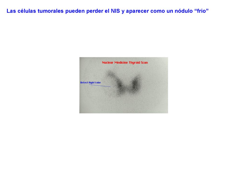 Las células tumorales pueden perder el NIS y aparecer como un nódulo frio