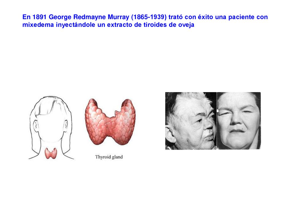 En 1891 George Redmayne Murray ( ) trató con éxito una paciente con mixedema inyectándole un extracto de tiroides de oveja