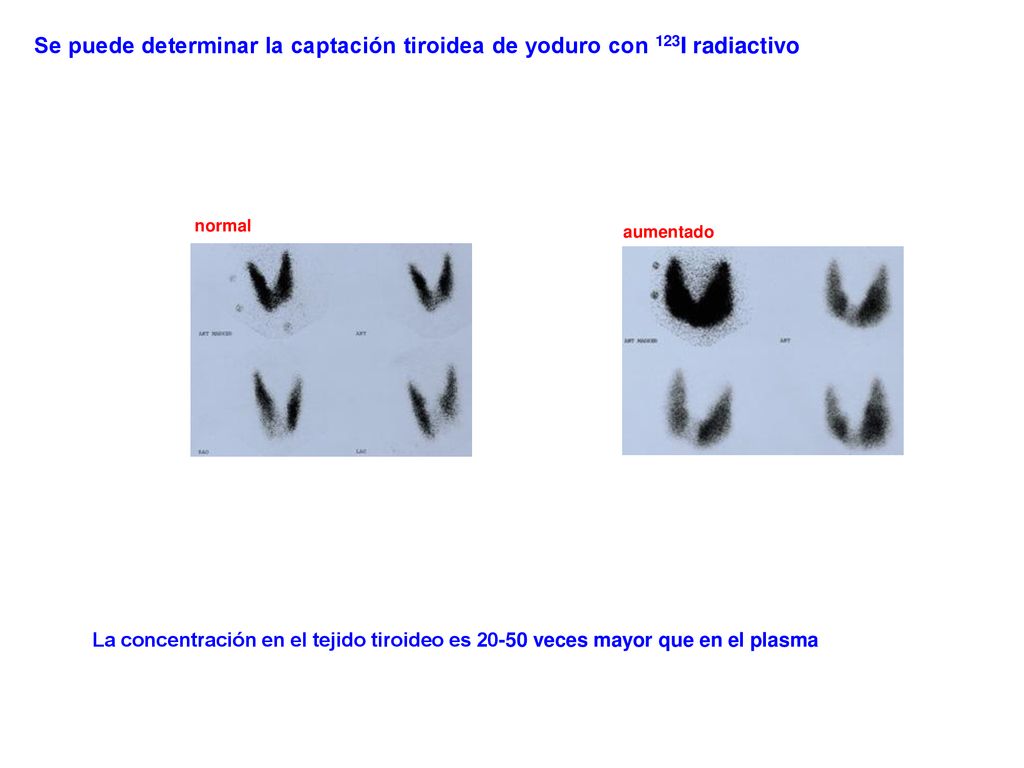 Se puede determinar la captación tiroidea de yoduro con 123I radiactivo