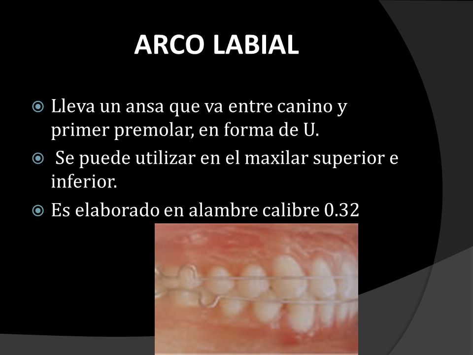 ARCO LABIAL Lleva un ansa que va entre canino y primer premolar, en forma de U. Se puede utilizar en el maxilar superior e inferior.