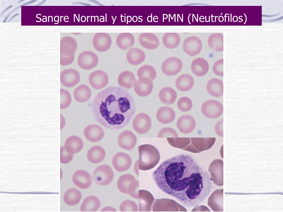 Sangre Normal y tipos de PMN (Neutrófilos)