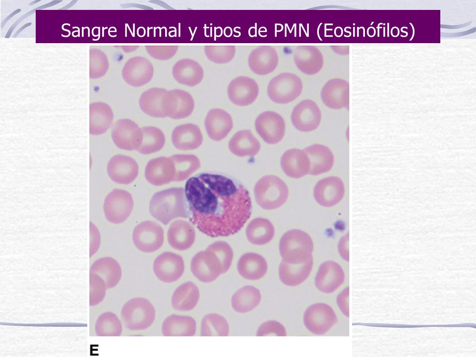 Sangre Normal y tipos de PMN (Eosinófilos)