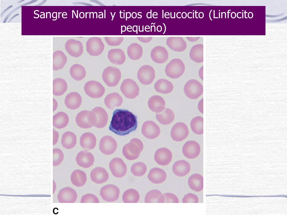 Sangre Normal y tipos de leucocito (Linfocito pequeño)