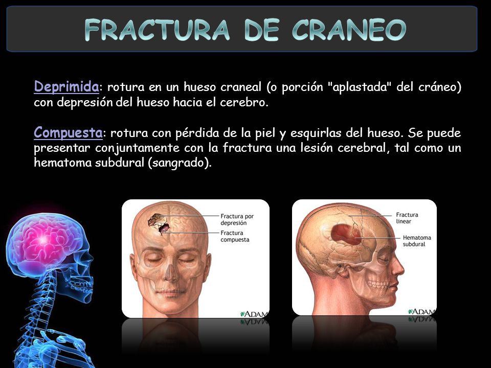 FRACTURA DE CRANEO Deprimida: rotura en un hueso craneal (o porción aplastada del cráneo) con depresión del hueso hacia el cerebro.
