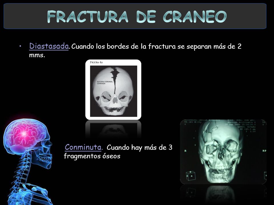 FRACTURA DE CRANEO Diastasada. Cuando los bordes de la fractura se separan más de 2 mms.