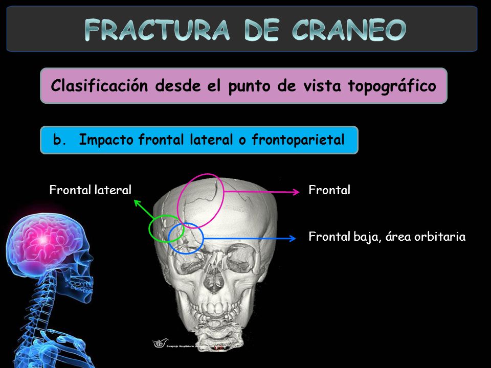 FRACTURA DE CRANEO Clasificación desde el punto de vista topográfico