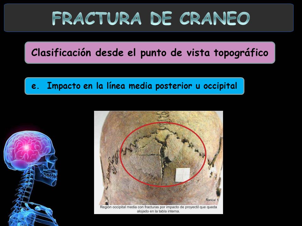 FRACTURA DE CRANEO Clasificación desde el punto de vista topográfico