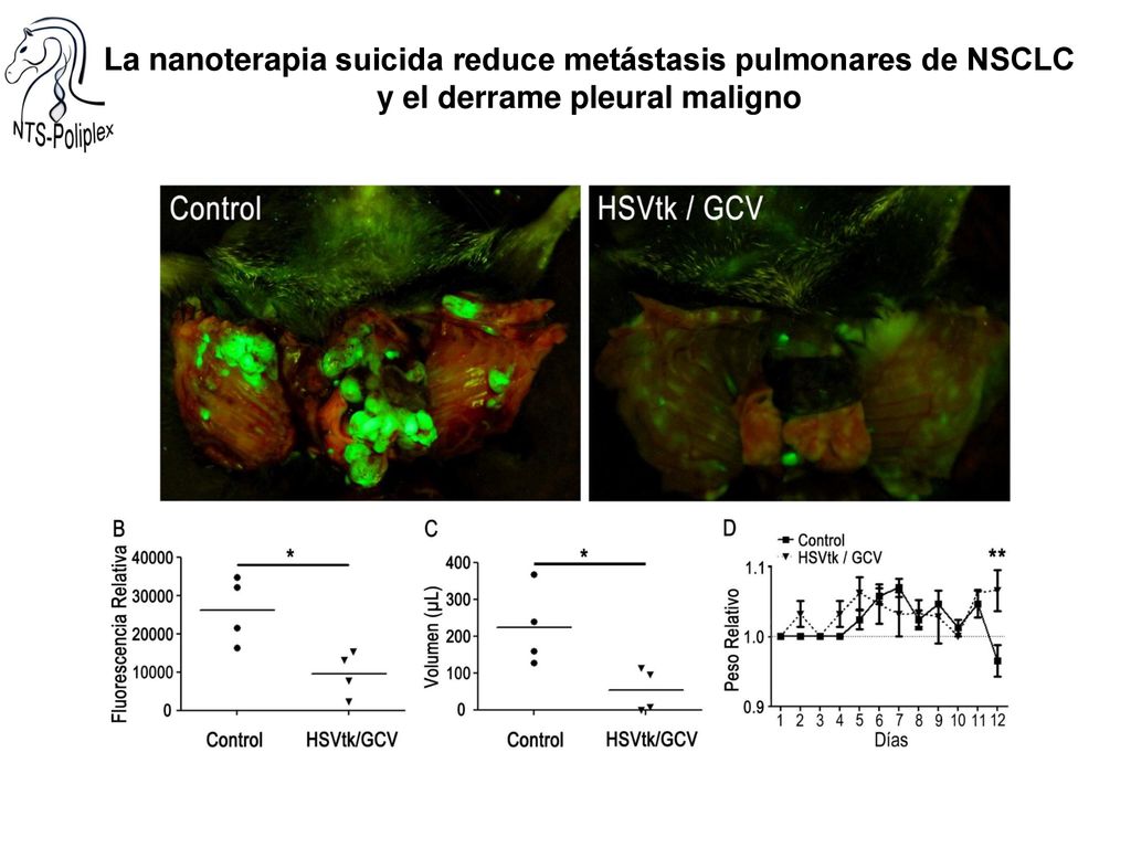 La nanoterapia suicida reduce metástasis pulmonares de NSCLC y el derrame pleural maligno