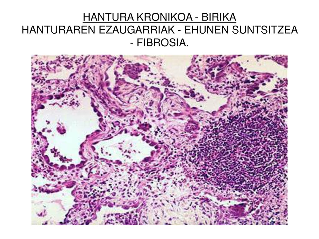HANTURA KRONIKOA - BIRIKA HANTURAREN EZAUGARRIAK - EHUNEN SUNTSITZEA - FIBROSIA.