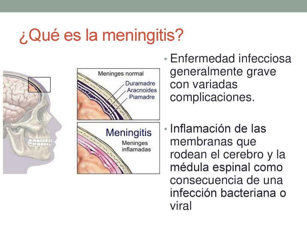 ¿Qué es la meningitis Enfermedad infecciosa generalmente grave con variadas complicaciones.