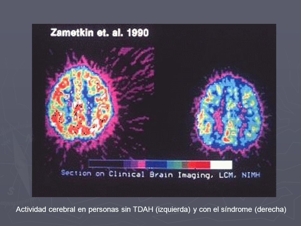 Actividad cerebral en personas sin TDAH (izquierda) y con el síndrome (derecha)