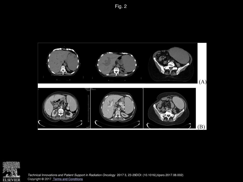 Fig. 2 Radiologic response to treatment. A. Spleen volume before radiotherapy. B. Spleen volume after low-dose radiotherapy.