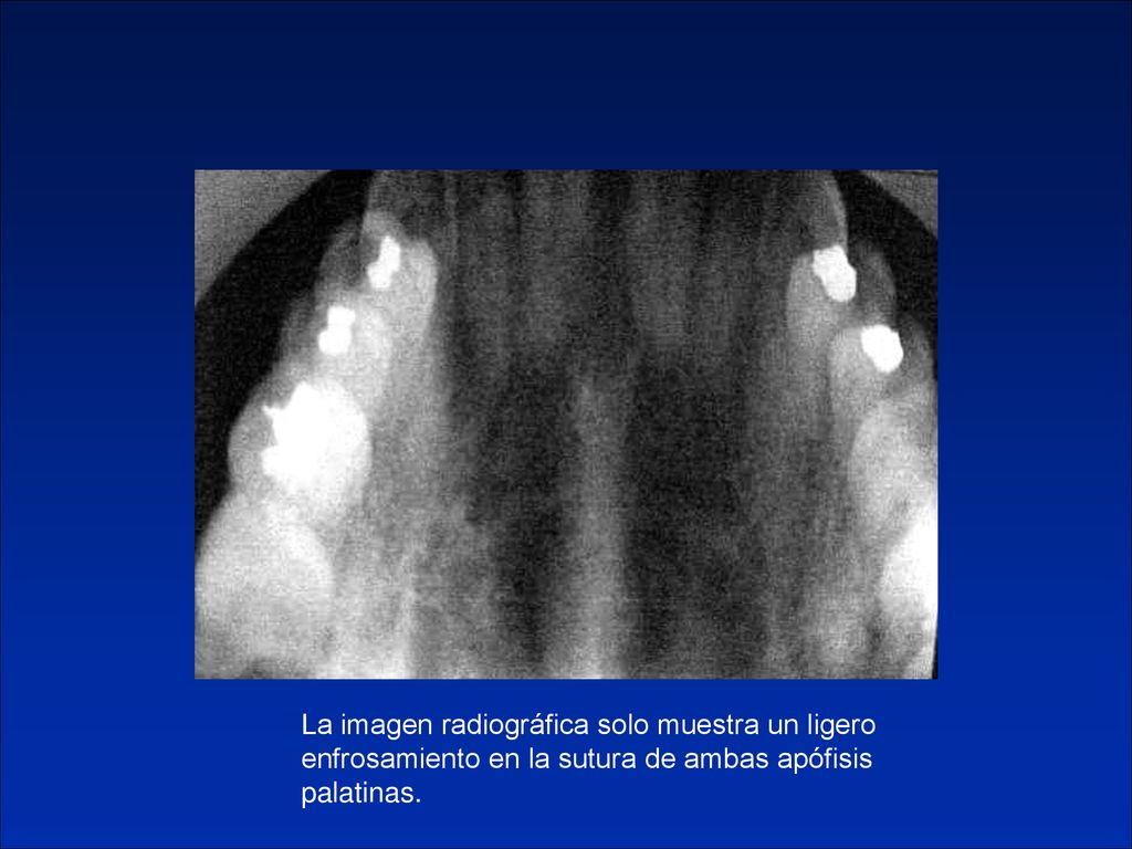 La imagen radiográfica solo muestra un ligero enfrosamiento en la sutura de ambas apófisis palatinas.