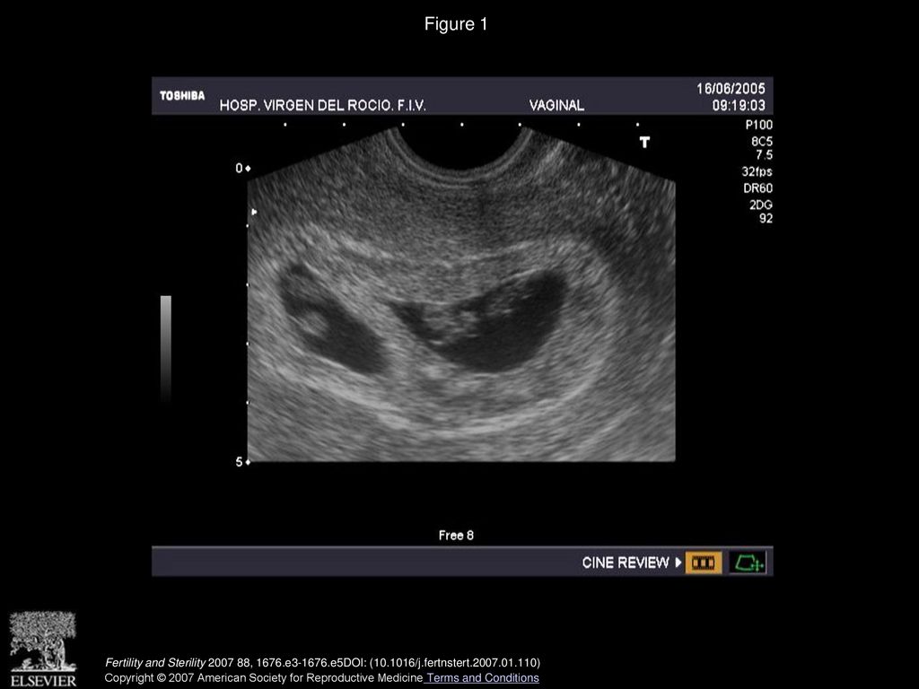 Figure 1 Ultrasonic image of a dichorionic–quadramniotic pregnancy (two sets of monozygotic twins) on day 36 of gestation.