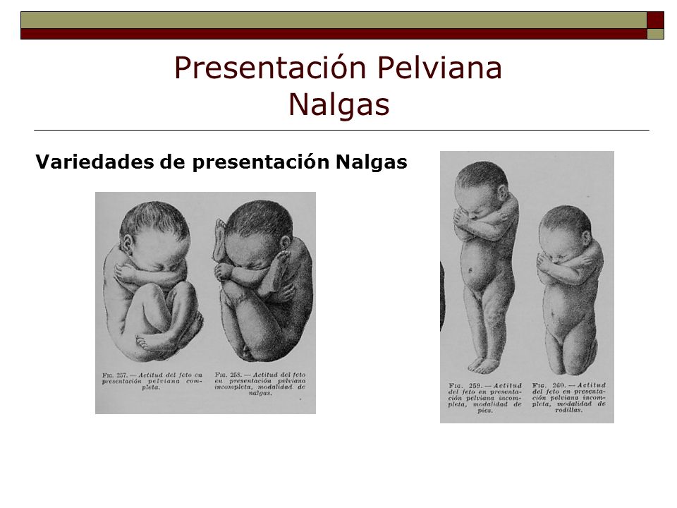 Presentación Pelviana Nalgas