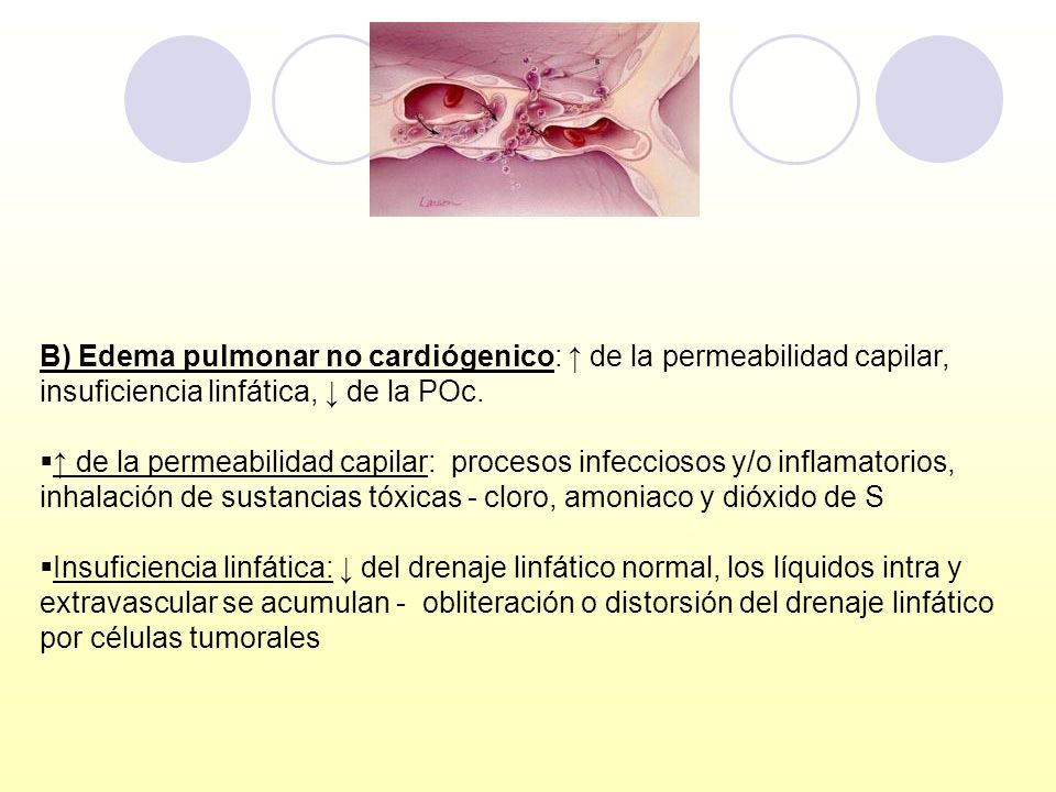 B) Edema pulmonar no cardiógenico: ↑ de la permeabilidad capilar, insuficiencia linfática, ↓ de la POc.