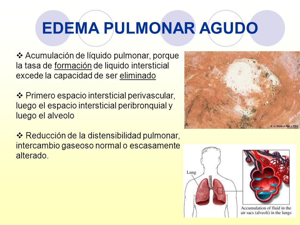 EDEMA PULMONAR AGUDO Acumulación de líquido pulmonar, porque la tasa de formación de liquido intersticial excede la capacidad de ser eliminado.