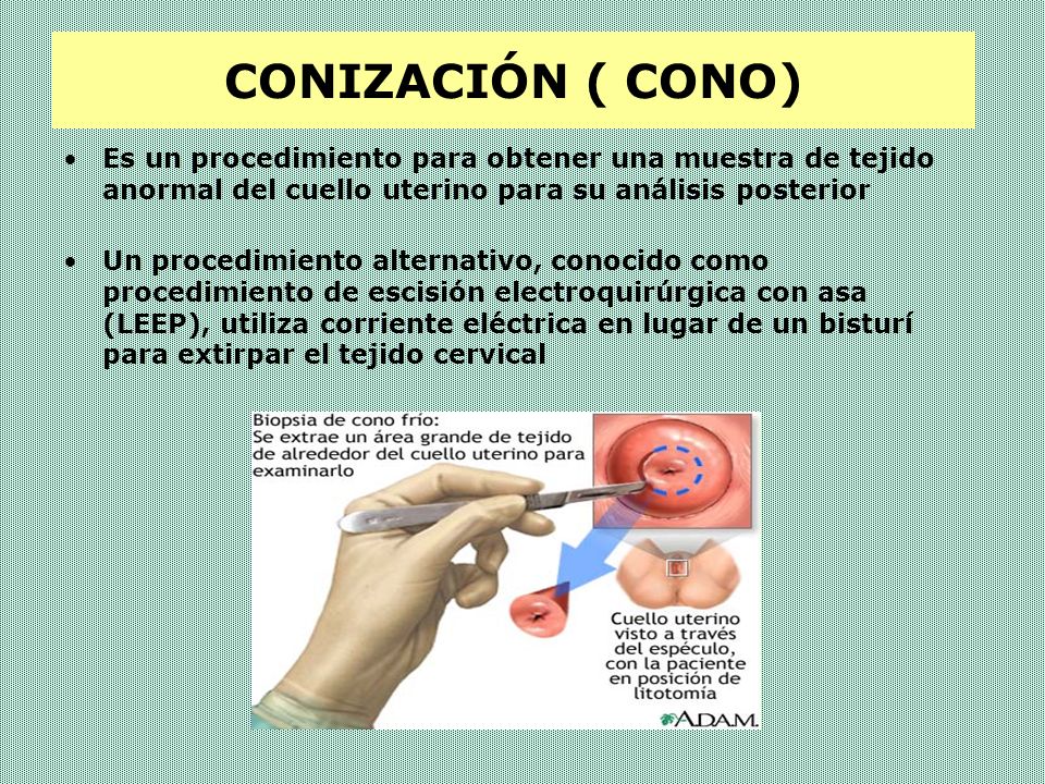 CONIZACIÓN ( CONO) Es un procedimiento para obtener una muestra de tejido anormal del cuello uterino para su análisis posterior.