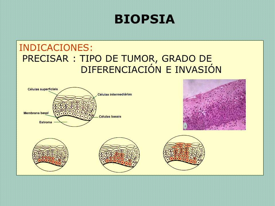BIOPSIA INDICACIONES: PRECISAR : TIPO DE TUMOR, GRADO DE