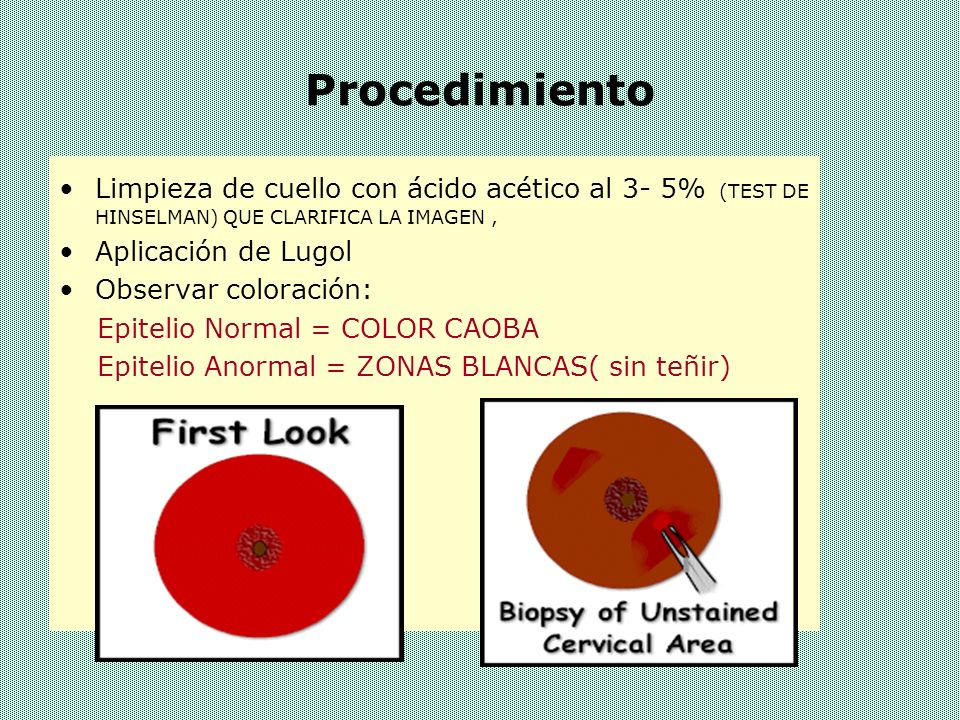Procedimiento Limpieza de cuello con ácido acético al 3- 5% (TEST DE HINSELMAN) QUE CLARIFICA LA IMAGEN ,