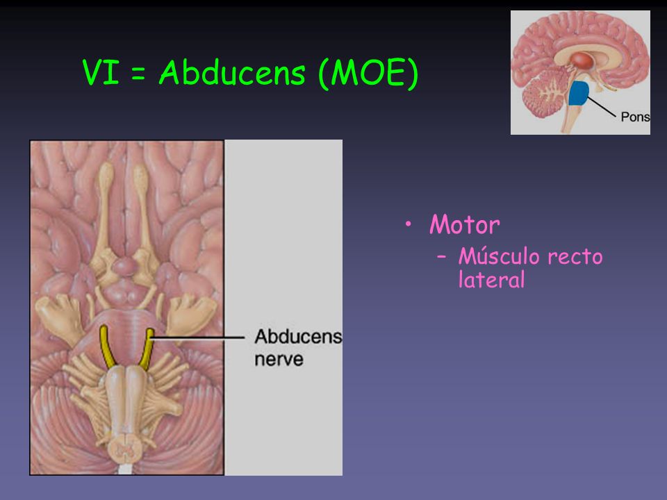 VI = Abducens (MOE) Motor Músculo recto lateral