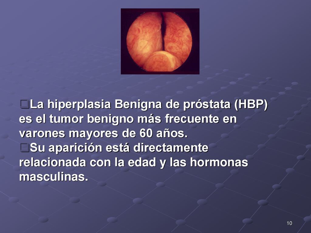 La hiperplasia Benigna de próstata (HBP) es el tumor benigno más frecuente en varones mayores de 60 años.