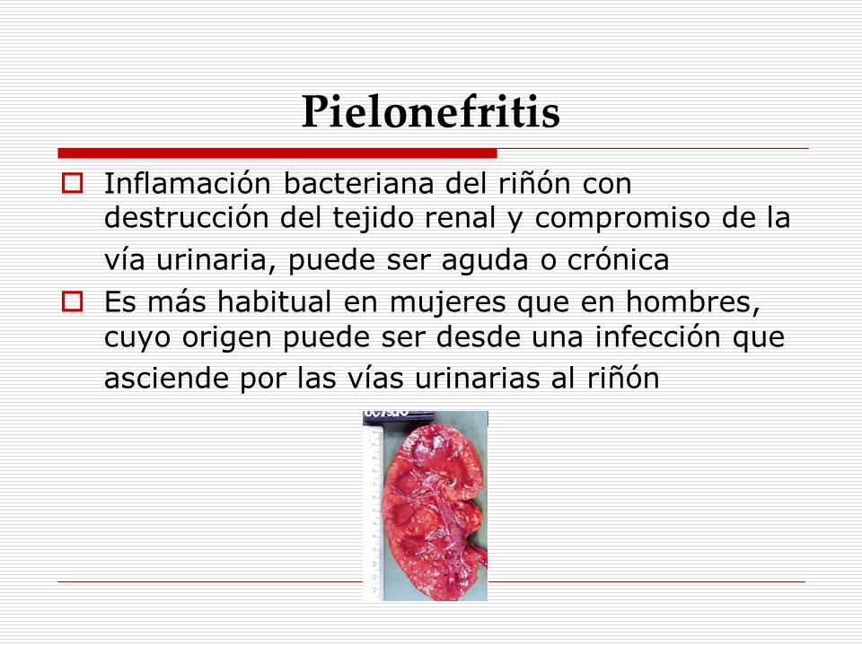 Pielonefritis Inflamación bacteriana del riñón con destrucción del tejido renal y compromiso de la vía urinaria, puede ser aguda o crónica.