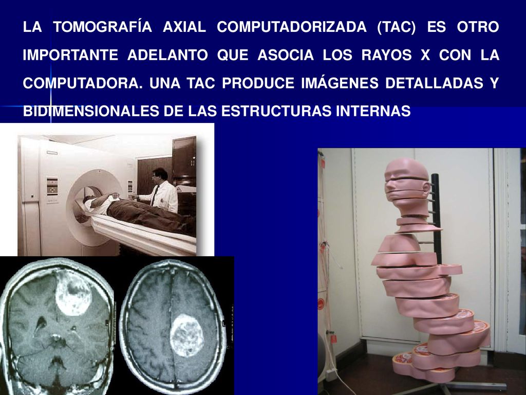 LA TOMOGRAFÍA AXIAL COMPUTADORIZADA (TAC) ES OTRO IMPORTANTE ADELANTO QUE ASOCIA LOS RAYOS X CON LA COMPUTADORA.